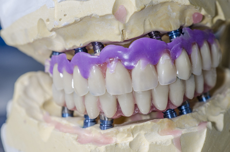 Closeup of dental prosthesis porcelain teeth in a mold.の写真素材