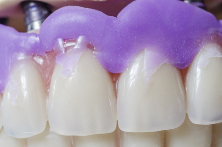 Closeup of dental prosthesis porcelain teeth in a mold.の写真素材