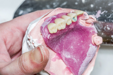 Closeup of dental technician is working with wax in dental mold in lab.の写真素材