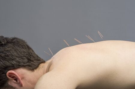 Chinese medicine doing acupuncture to man patientの写真素材