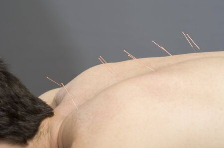 Chinese medicine doing acupuncture to man patientの写真素材
