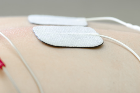 TENS electrodes positioned for back pain treatment in physical therapy.の写真素材