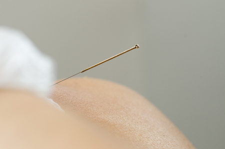 Closeup of a needle and hands of physiotherapist doing a dry needling.の写真素材