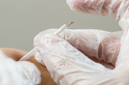 Closeup of a needle and hands of physiotherapist doing a dry needling.の写真素材