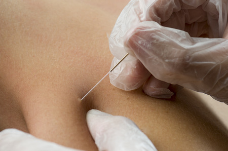 Closeup of a needle and hands of physiotherapist doing a dry needling.の写真素材