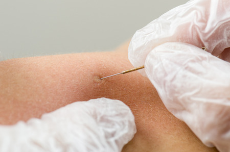 Closeup of a needle and hands of physiotherapist doing a dry needling.の写真素材
