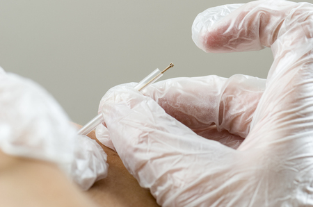 Closeup of a needle and hands of physiotherapist doing a dry needling.の写真素材