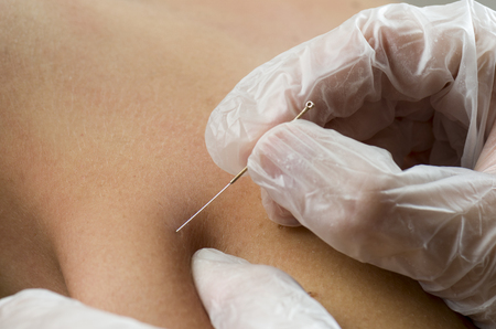 Closeup of a needle and hands of physiotherapist doing a dry needling.の写真素材