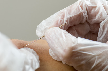Closeup of a needle and hands of physiotherapist doing a dry needling.の写真素材