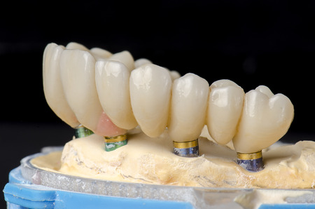 Monolithic zirconia restorations full arch implant supported with the ceramic load in vestibular, back background.の写真素材