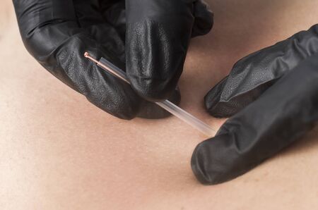 Dry needling, closeup of a physiotherapist with a needle and black gloves.の写真素材