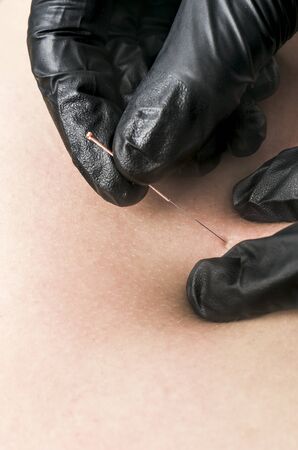 Dry needling, closeup of a physiotherapist with a needle and black gloves.の写真素材