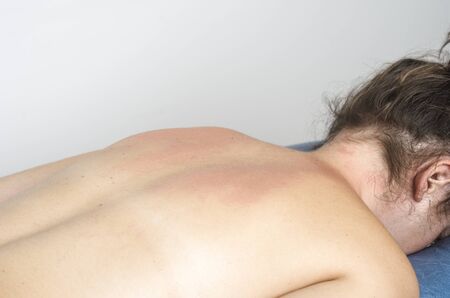 Redness after a massage in the back of patient.の写真素材