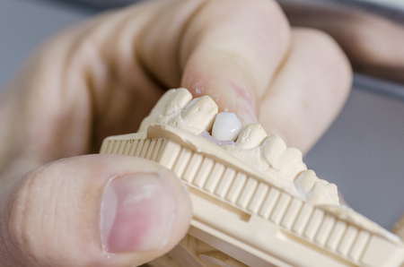 Dental technician putting a ceramic tooth in a dental cast model.