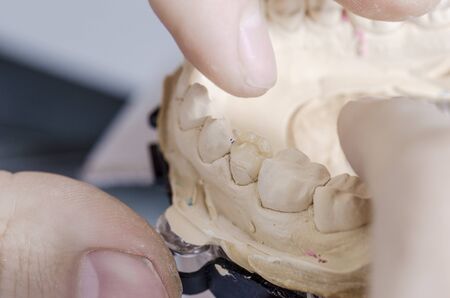 Dental technician putting a ceramic tooth in a dental cast model.