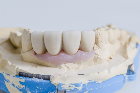 Dental technician working in a metal ceramic crowns.の写真素材