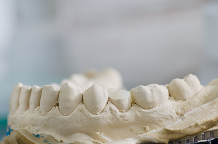 Hybrid ceramic crown in a dental cast model.の写真素材