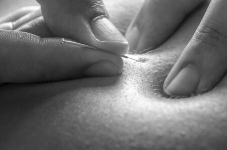 Physitoterapist / chiroprator doing a back massage. Osteopathy.の写真素材