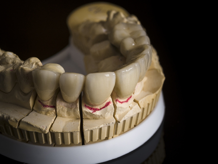 Monolithic zirconia restorations  implant supported with the ceramic load in vestibular, back backgroundの写真素材