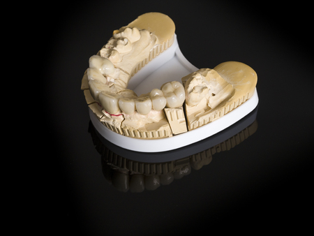 Monolithic zirconia restorations  implant supported with the ceramic load in vestibular, back...