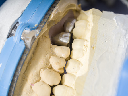 Dental technician is working with articulator in metal structure of a dental crown or bridge in...
