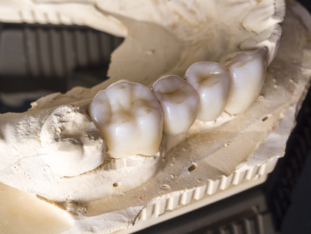 Monolithic zirconia restorations  implant supported with the ceramic load in vestibular, back backgroundの写真素材
