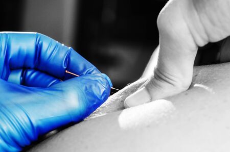 Closeup of a needle and hands of physiotherapist doing a dry needling in silhouette studio on white background.の写真素材