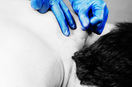 Chinese medicine doing acupuncture to man patient in silhouette studio.