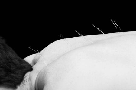 Chinese medicine doing acupuncture to man patient in silhouette studio over black.の写真素材