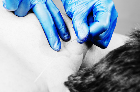 Chinese medicine doing acupuncture to man patient in silhouette studio.の写真素材