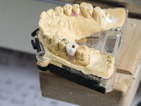 Closeup of dental technician applying ceramic to teeth, implant before putting into the furnace.の写真素材