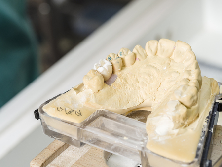 Closeup of dental technician applying ceramic to teeth, implant before putting into the furnace.