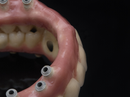  Complete prosthesis dental screwed over black mirror. Reflectionの写真素材