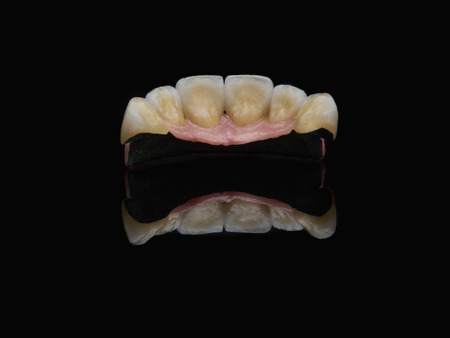 Metal ceramic bridge with pink gum. Fixed implant denture over black glass mirrow with reflexion. 