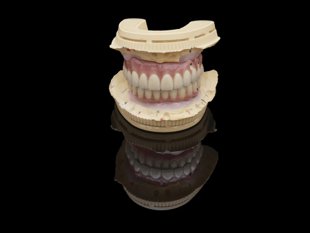 Complete lower and upper metal ceramic prosthesis dental screwed directly to implant.