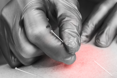 Needle and hands of physiotherapist doing a dry needling. Chinese medicine doing acupuncture to man patient.の写真素材