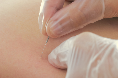 Closeup of a needle and hands of physiotherapist doing a dry needlingの写真素材