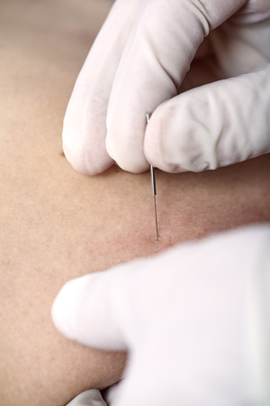Chiropractor doing dry needling, closeup of a needle and hands. Physiotherapist, osteopath, manual therapy, acupressure. Acupuncture, alternative medicine.の写真素材