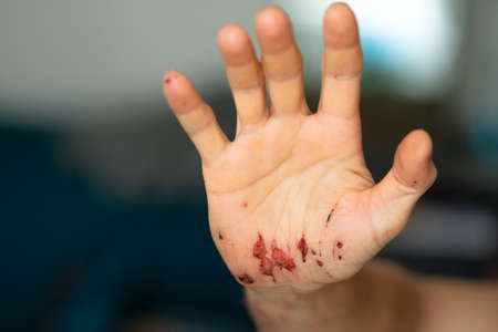 Wounds on the inside of the palm of an adult males right hand after removing the bandages. Close-up.の写真素材