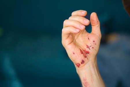 Abrasions on the palm and scratches on the right arm of an adult man. Home treatment.の写真素材