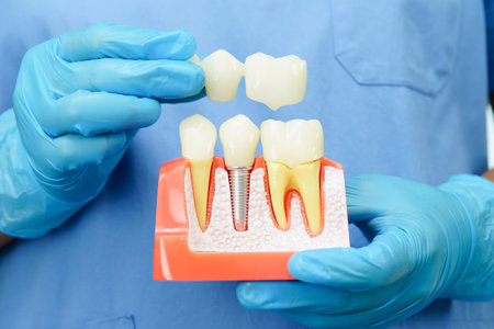 Dentist holding dental implant, artificial tooth roots into jaw, root canal of dental treatment, gum disease, teeth model for dentist.の写真素材