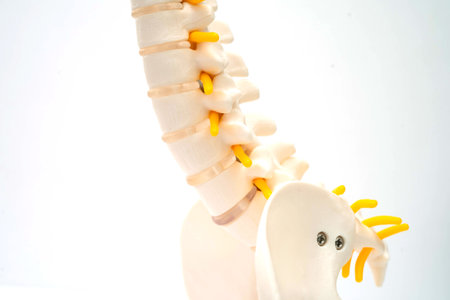 Spinal nerve and bone, Lumbar spine displaced herniated disc fragment, Model for treatment medical...