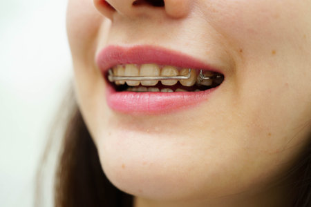 Asian woman wearing Hawley retainer removable orthodontic appliance maintain position of teeth.の写真素材