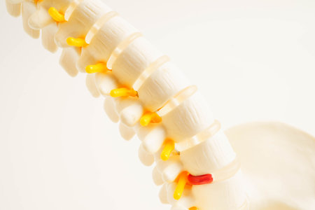Spinal nerve and bone, Lumbar spine displaced herniated disc fragment, Model for treatment medical...
