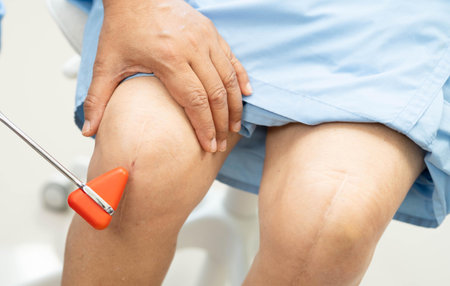 Doctor neurologist testing reflex knee with hammer and show Asian senior scars surgical total knee...