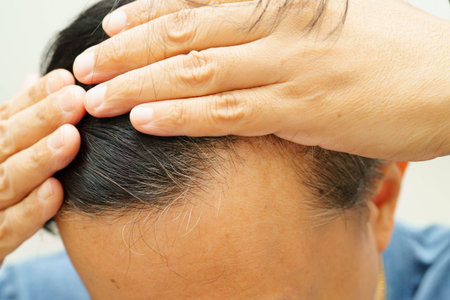 Bald head in man, hair loss treatment health problem.