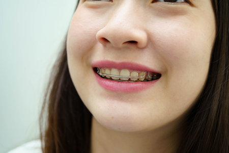 Asian woman wearing Hawley retainer removable orthodontic appliance maintain position of teeth.の写真素材