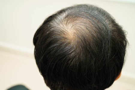 Bald head in man, hair loss treatment health problem.