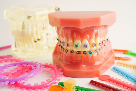 Orthodontic ligatures rings and ties, elastic rubber bands on orthodontic braces, model for dentist...