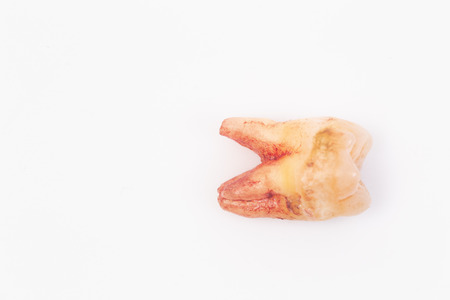 Caries on the teeth on the white backgroundの写真素材